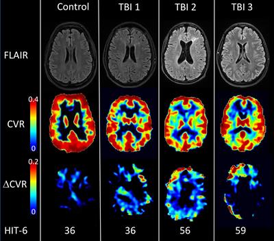 Cerebrovascular Reactivity Measures Are Associated With Post-traumatic Headache Severity in Chronic TBI; A Retrospective Analysis